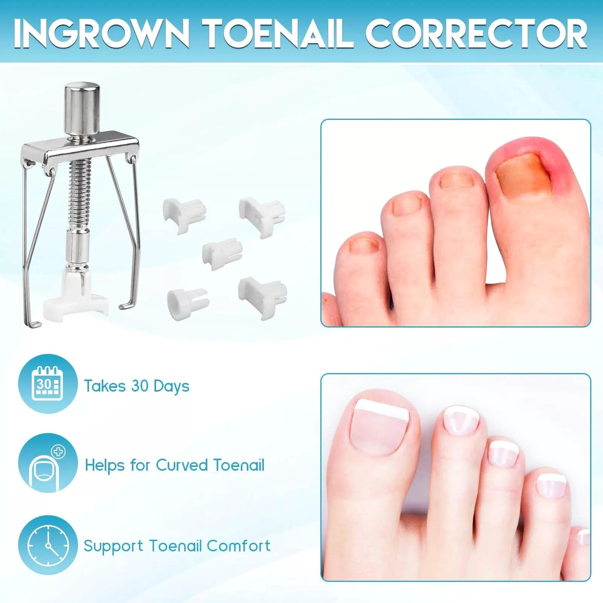 Ingrown Toenail Removal Kit, Professional 1 Fl Oz (Pack of 1), Silver [6]