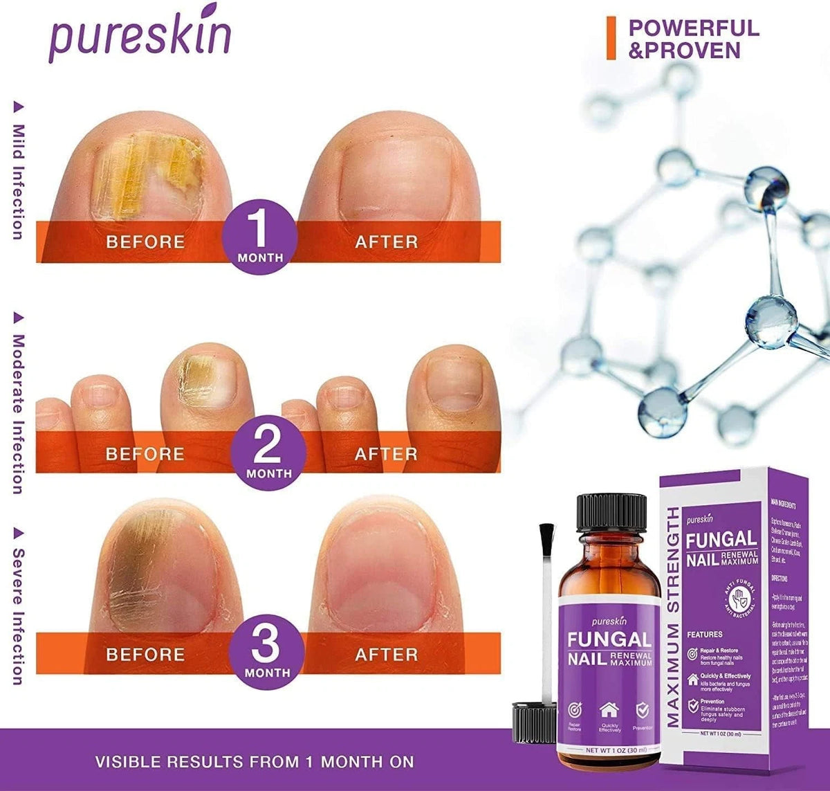 Toenail Fungus Treatment Extra Strength Kit, 1 Fl Oz (Pack of 1), Purple