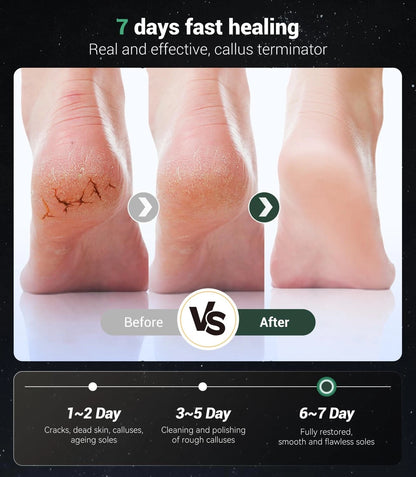 5-in-1 Professional Electric Callus Remover(Portable & Gunmetal Gray