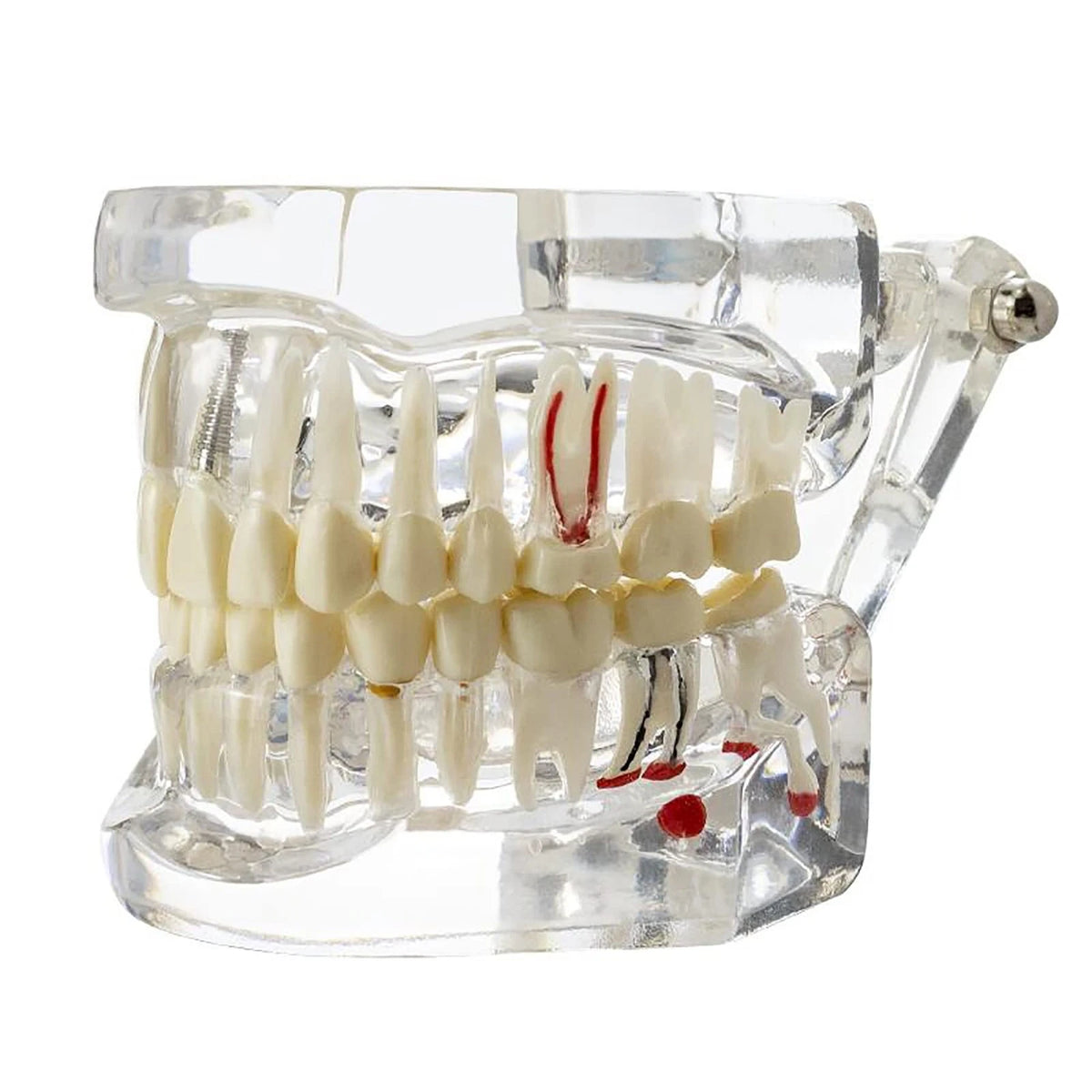 Dentalmall Dental Oral Typodont Model Implant Standard Size, Clear