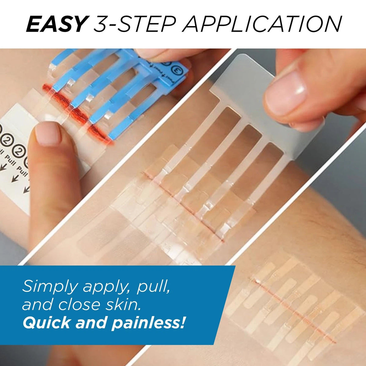 Clozex Emergency Laceration Kit - Repair Wounds Without Stitches, 1.5 Inch