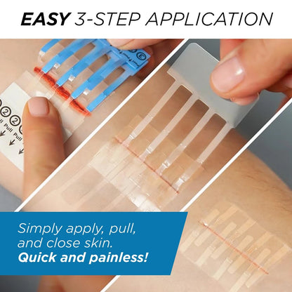 Clozex Emergency Laceration Kit - Repair Wounds Without Stitches, 1.5 Inch