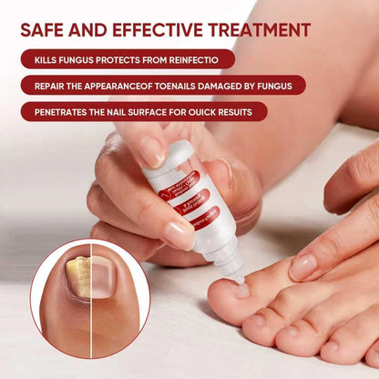 DERMFREE Toenail Treatment,Gentle Formula, 0.5 Fl Oz (Pack of 1), red